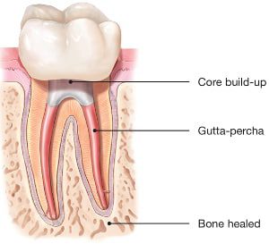 Healed-Tooth-Following-Root-Canal
