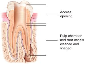 Root-Canal-Access-Openi