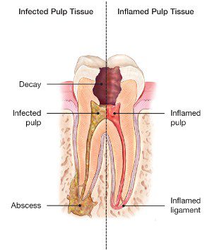 Root-canal-image 1