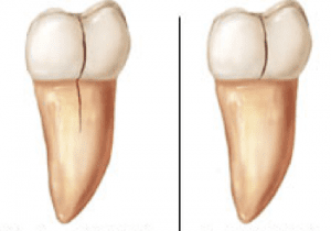 cracked tooth