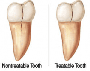 cracked tooth