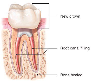 endodontic-retreatment-root-canal-crown