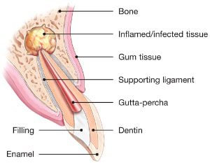 endodontic-surgery-explained