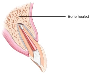 endodontic-surgery-healed