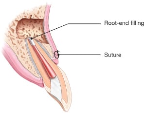 endodontic-surgery-root-end-filling