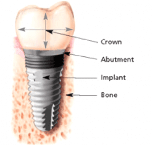 implant